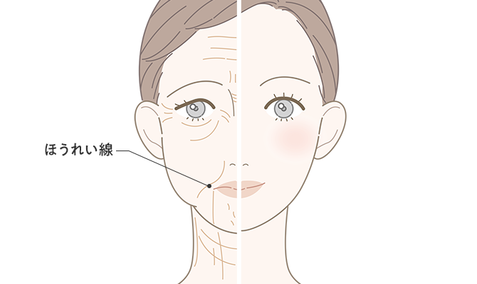 頬のたるみ（ほうれい線）