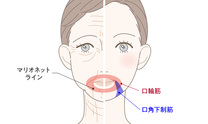 口元のたるみ（マリオネットライン）