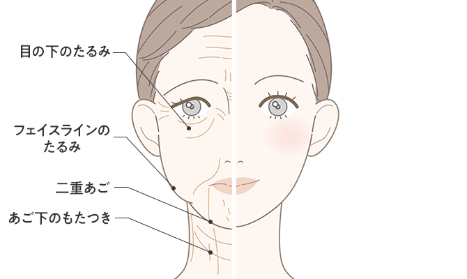 フェイスラインや目の下のたるみ