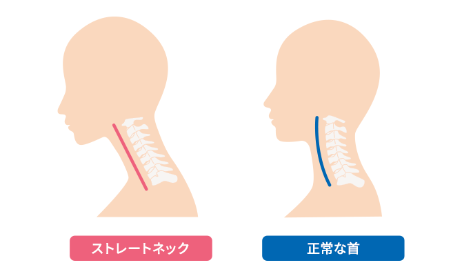 ストレートネックと正常な首