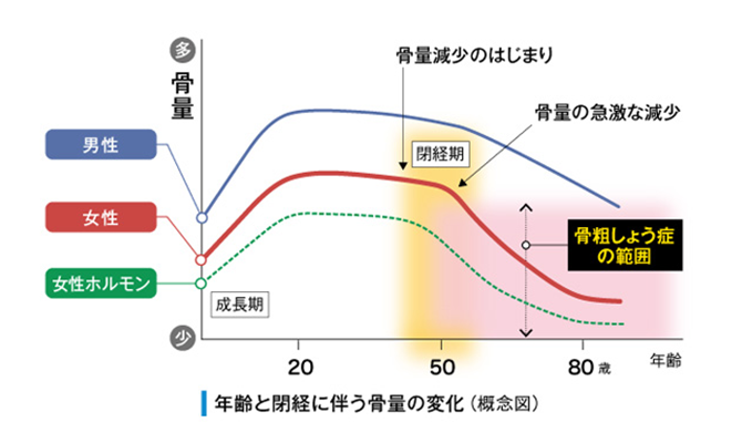 年齢と閉経に伴う骨量の変化（概念図）