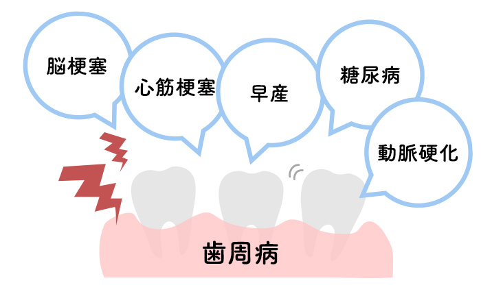 歯周病が脳梗塞・心筋梗塞・早産・糖尿病・動脈硬化などに関わっている図